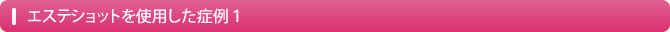 エステショットを使用した症例１