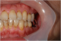 エステショットを使用した症例１の術前写真