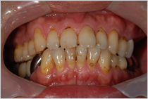 エステショットを使用した症例１の術前写真
