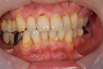 エステショットを使用した症例１の術後写真