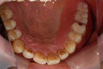 エステショットを使用した症例１の術後写真