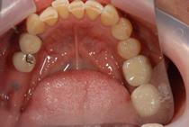 エステショットを使用した症例２の術前写真