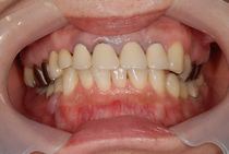 エステショットを使用した症例２の術後写真