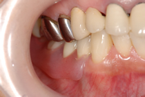 エステショットを使用した症例２の術後写真