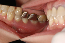 エステショットを使用した症例２の術後写真