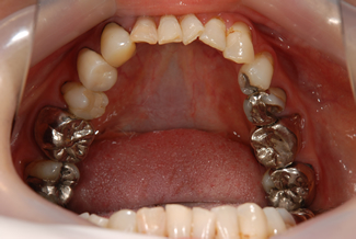 グラディアフォルテを使用した症例１の術前写真