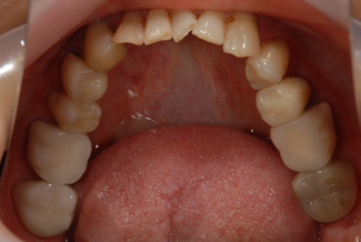 グラディアフォルテを使用した症例１の術前写真