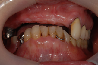 ルシトーンを使用した症例１の術前写真