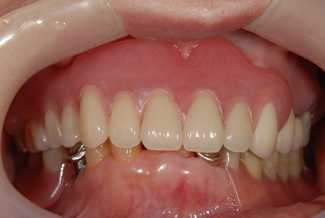 ルシトーンを使用した症例１の術前写真