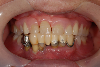 ルシトーンを使用した症例２の術前写真