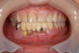 ルシトーンを使用した症例２の術前写真