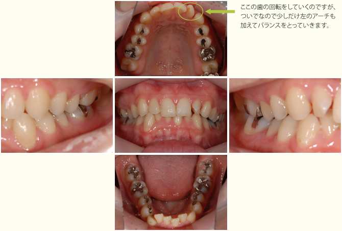 クリアープラスチックアプライアンスシステム１の症例写真