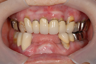 バルプラストの術前写真