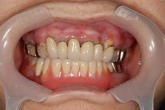 バルプラストの術前写真