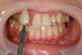 ホワイトニングの術前写真