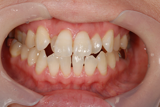 ホワイトニングの術前写真