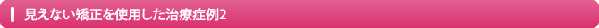 見えない矯正を使用した治療症例2