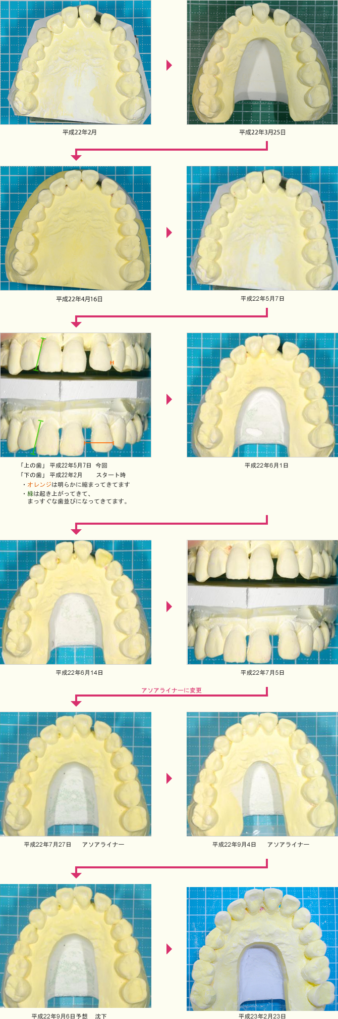 見えない矯正を使用した治療症例