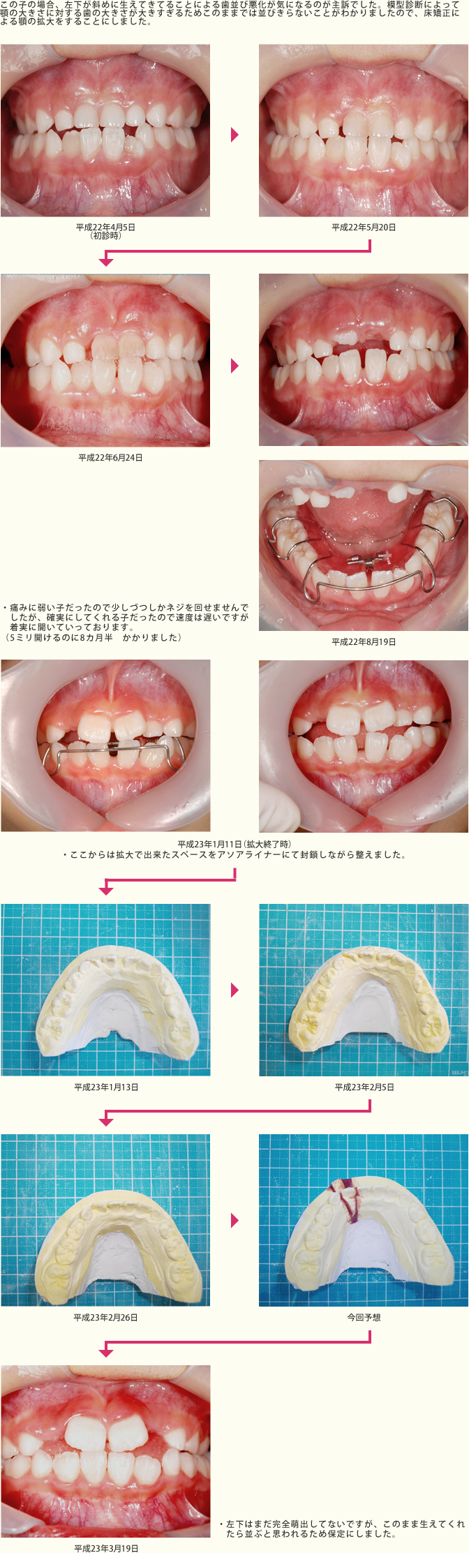 見えない矯正を使用した治療症例2