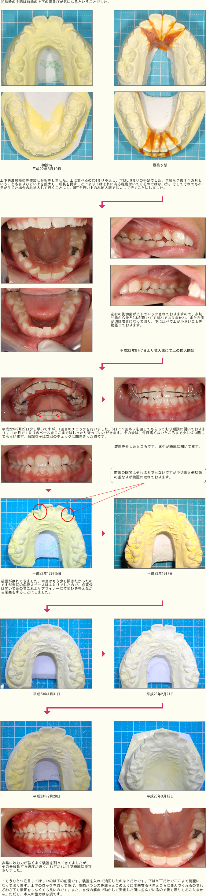 拡大床からアライナーへ移行とMFT症例