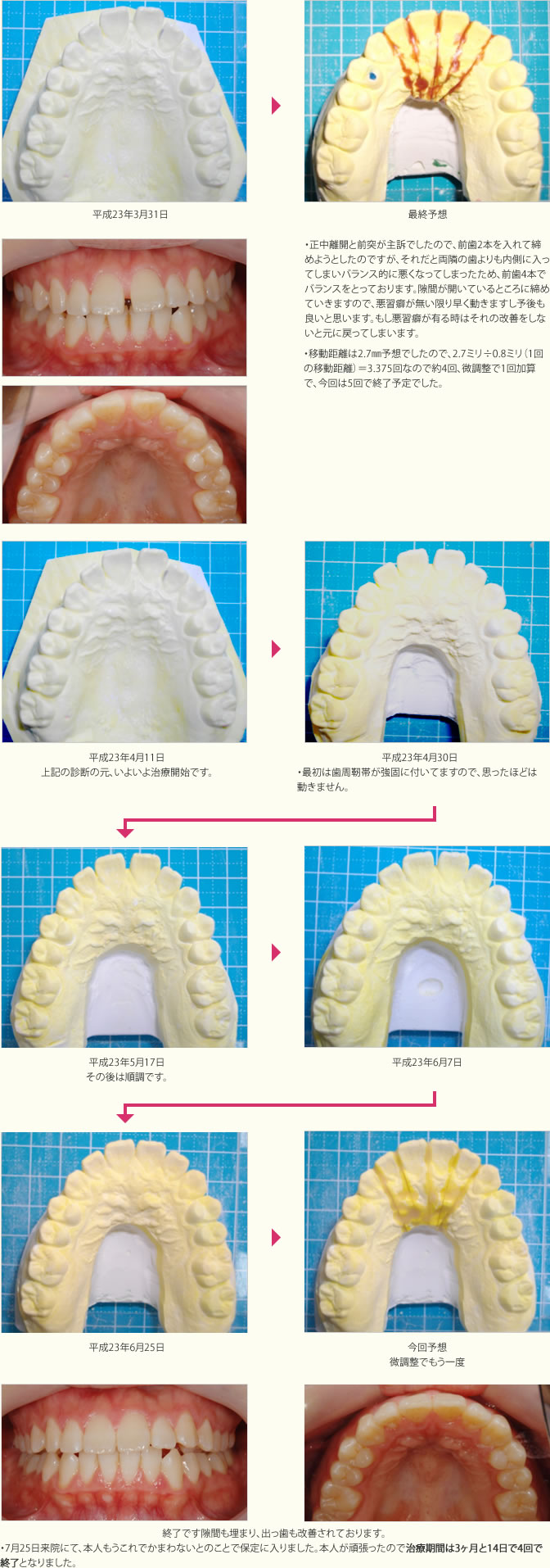 正中離開と前突